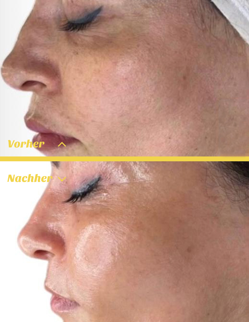Vorher-Nachher Vergleich Hydrafacial Behandlung in Stuttgart – sichtbar klarere Haut