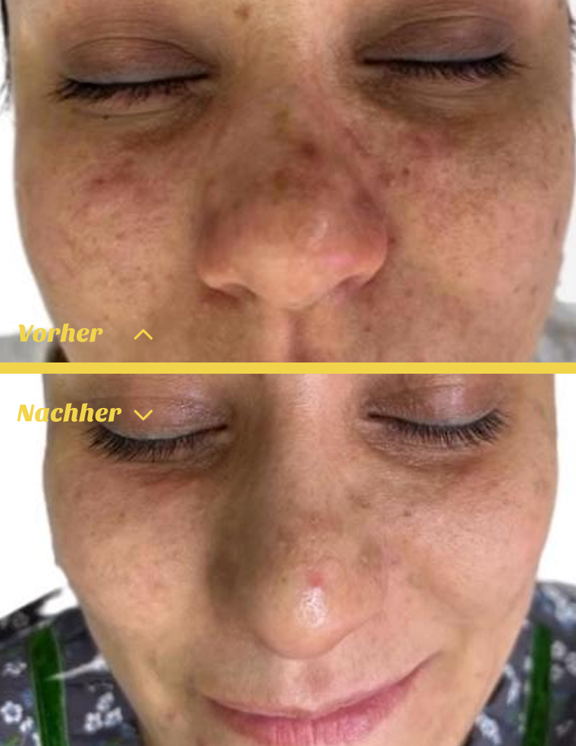 Ergebnis eines Hydrafacials in Stuttgart – reine Haut im Vorher-Nachher Vergleich
