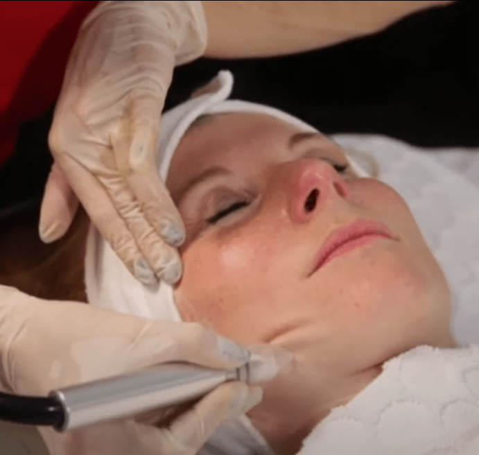 MMicrodermabrasion Gesichtsbehandlung Stuttgart &ndash; sanfte Hauterneuerung und verfeinertes Hautbild im House of Glam