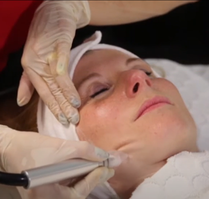 MMicrodermabrasion Gesichtsbehandlung Stuttgart – sanfte Hauterneuerung und verfeinertes Hautbild im House of Glam