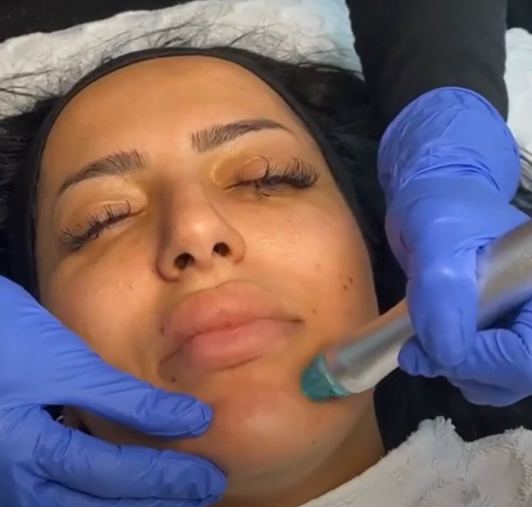 Hydrafacial Gesichtsbehandlung Stuttgart – porentiefe Reinigung und frische Haut im House of Glam