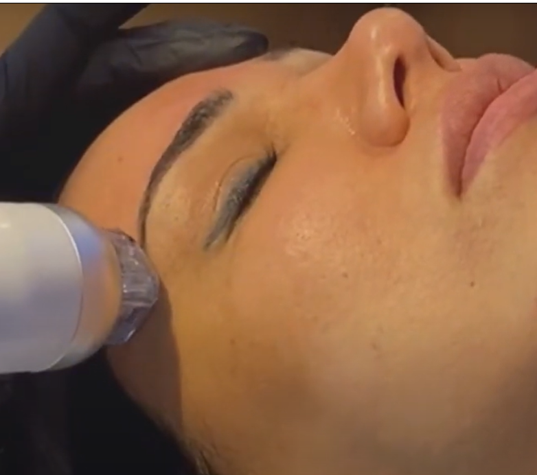 Radiofrequenz Microneedling Gesichtsbehandlung Stuttgart – straffende und regenerative Facial-Technologie im House of Glam