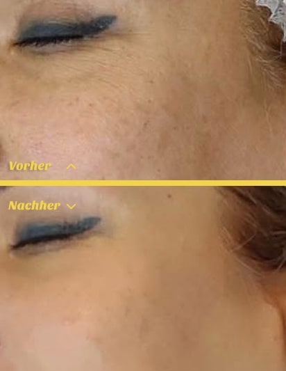 Hydrafacial Behandlung in Stuttgart f&uuml;r frische und strahlende Haut