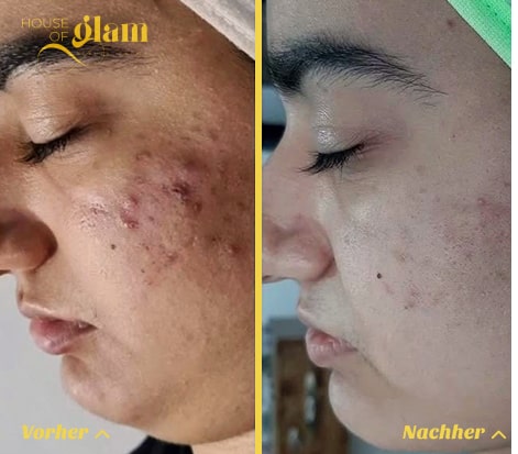 Hautverj&uuml;ngung mit Hydrafacial im House of Glam Stuttgart