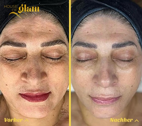 Hydrafacial Stuttgart &ndash; effektive Pflege gegen Hautunreinheiten