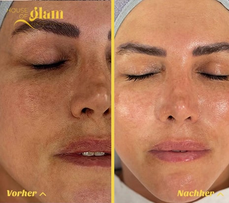 Hydrafacial Behandlung in Stuttgart Mitte f&uuml;r frischen Glow