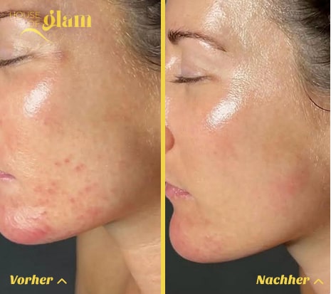 Professionelles Hydrafacial in Stuttgart f&uuml;r reine, gepflegte Haut