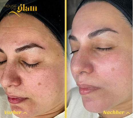 Luxuri&ouml;se Hydrafacial Gesichtsbehandlung in Stuttgart Mitte