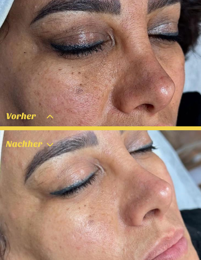 Professionelle Hydrafacial Hautpflege Stuttgart mit Tiefenreinigung