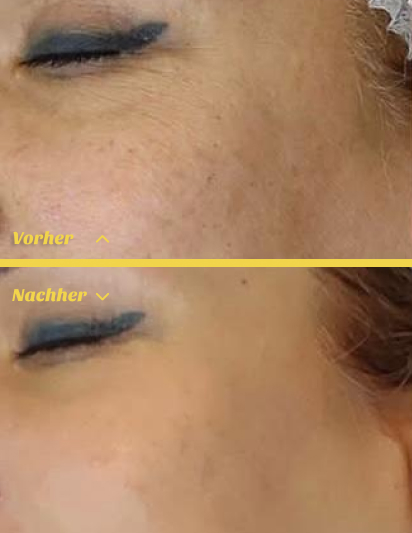 Hydrafacial Behandlung in Stuttgart für frische und strahlende Haut