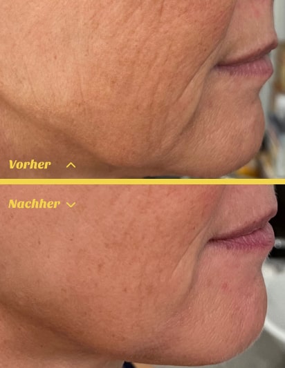 Radiofrequenz Microneedling Behandlung f&uuml;r straffe Haut in Stuttgart