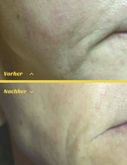 Hautverj&uuml;ngung durch Radiofrequenz Microneedling im Kosmetikstudio Stuttgart Mitte