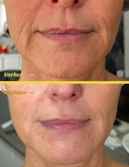 Schonendes Radiofrequenz Microneedling zur Hautregeneration in Stuttgart