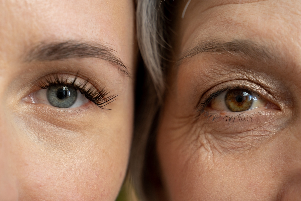 RF Needling rund um die Augen