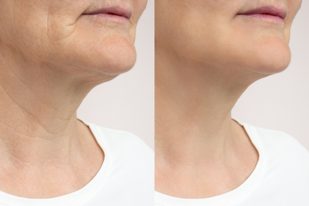 RF Needling ganzes Gesicht und am Hals