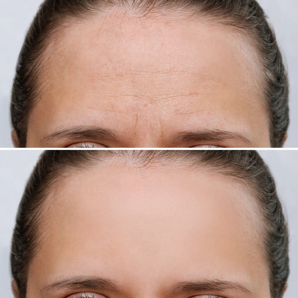 RF Needling ganze Stirn